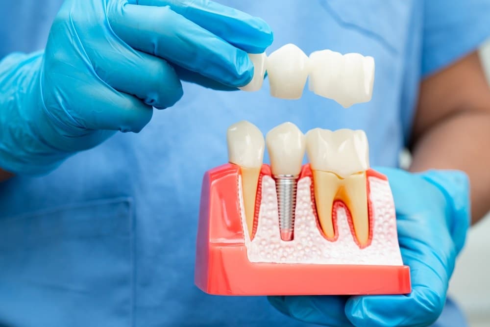 Why Missing Teeth Should Be Replaced With Dental Implants