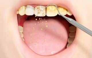 How Root Planing Can Help Save Natural Teeth