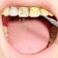 How Root Planing Can Help Save Natural Teeth