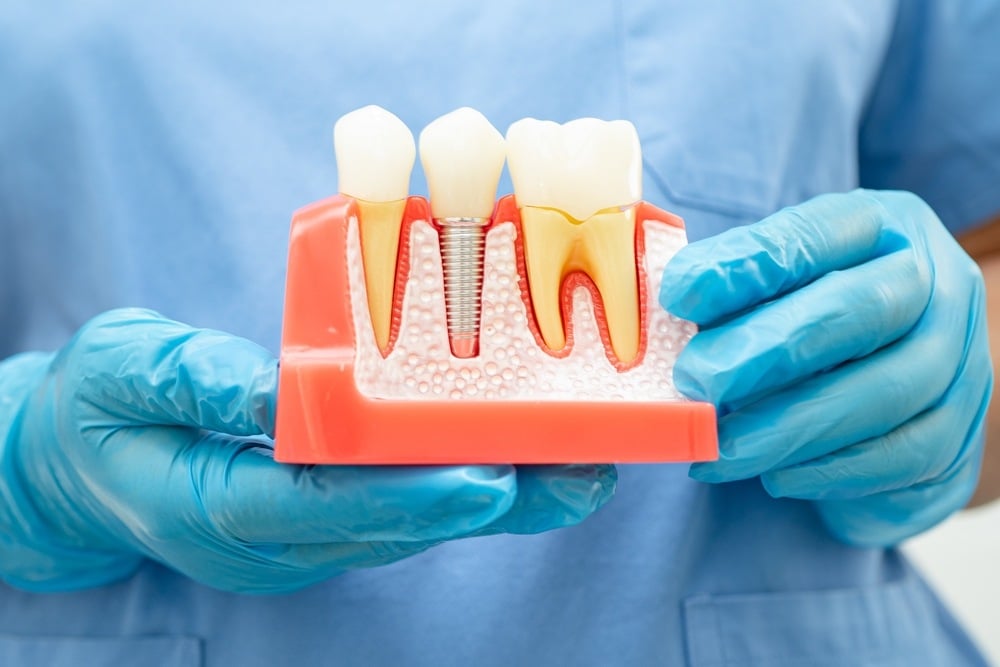 How Dental Implants Help Restore Your Smile and Bite Function