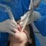 When Root Planing Is Needed to Treat Early Gum Disease