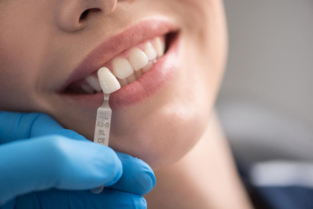 Why Dental Crowns Are Important for Protecting Damaged Teeth